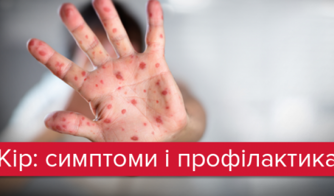 Кір – профілактика, ознаки, лікування Кір – профілактика, ознаки, лікування